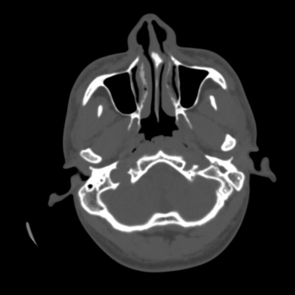 File:Occipital spur - asymptomatic (Radiopaedia 87753-104201 Axial bone window 13).jpg