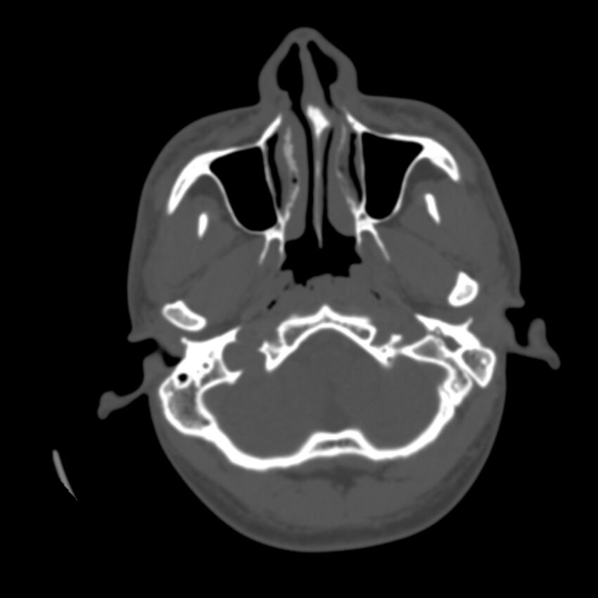 Occipital spur - asymptomatic (Radiopaedia 87753-104201 Axial bone window 13).jpg