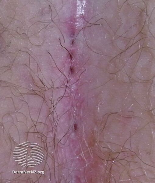 File:Pilonidal sinus (DermNet NZ acne-pilonidal2).jpg