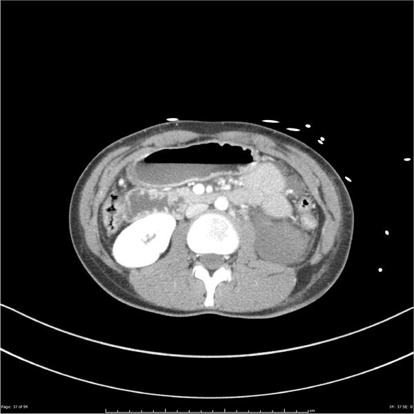 File:Traumatic renal artery dissection and pancreatic transection (Radiopaedia 37061-38739 Axial 229).jpg