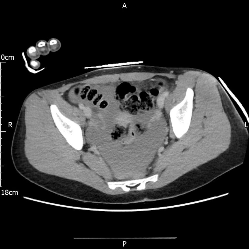 AAST grade IV kidney injury with CEUS follow-up (Radiopaedia 72353-82877 Axial C+ portal venous phase 66).jpg