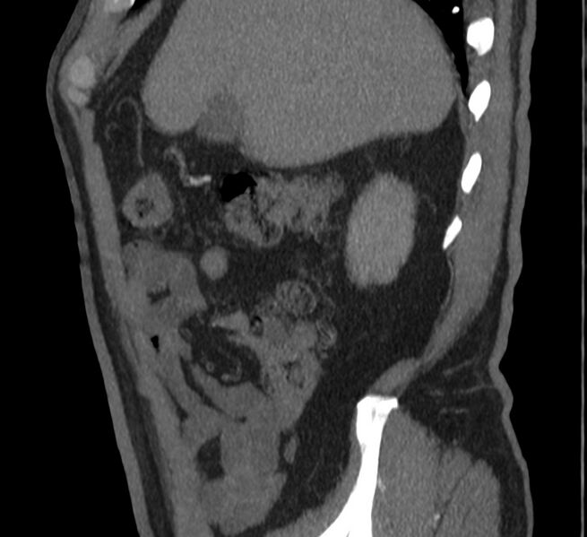 File:Abdominal aortic aneurysm (Radiopaedia 22421-22458 D 1).jpg