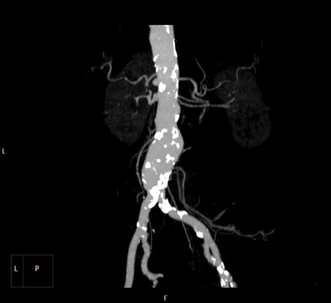 File:Abdominal aortic aneurysm (Radiopaedia 23703-23856 MIP 15).jpg