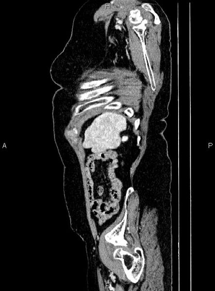 File:Abdominal aortic aneurysm (Radiopaedia 85063-100606 Sagittal C+ arterial phase 73).jpg