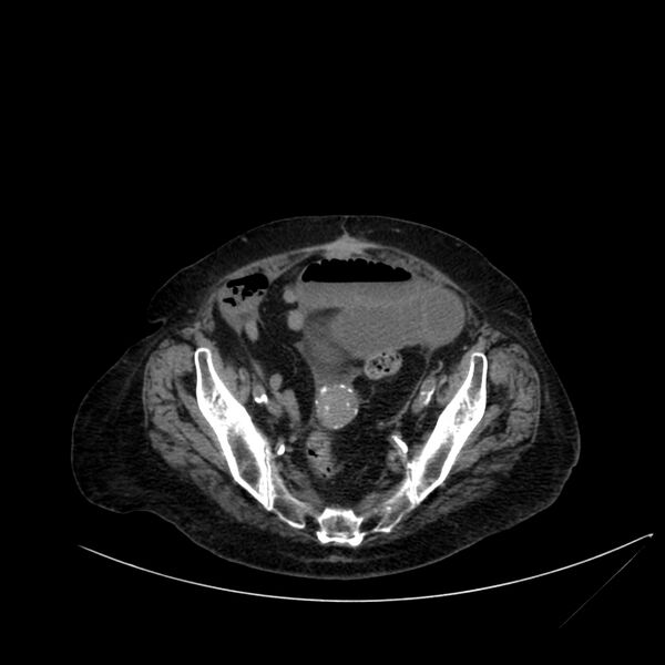 File:Abdominal aortic aneurysm - impending rupture (Radiopaedia 19233-19246 Axial non-contrast 102).jpg
