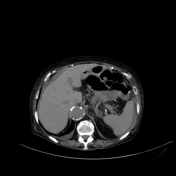 File:Abdominal aortic aneurysm - impending rupture (Radiopaedia 19233-19246 Axial non-contrast 31).jpg