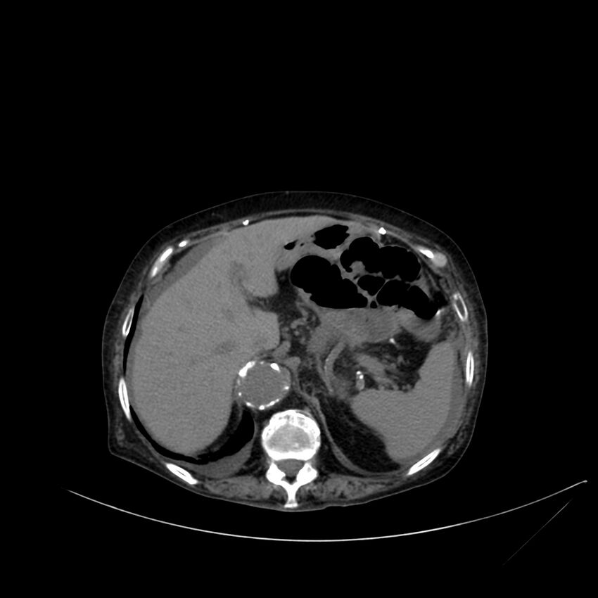 Abdominal aortic aneurysm - impending rupture (Radiopaedia 19233-19246 Axial non-contrast 31).jpg