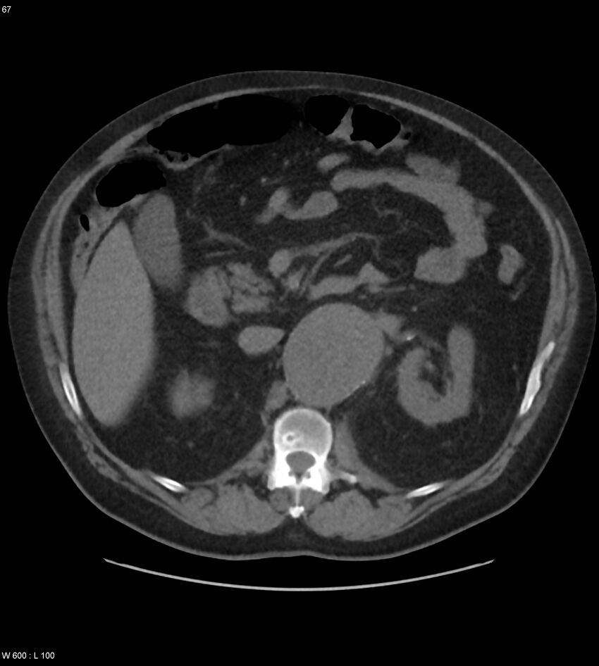 Abdominal aortic aneurysm with intramural hematoma then rupture (Radiopaedia 50278-55631 Axial non-contrast 63).jpg