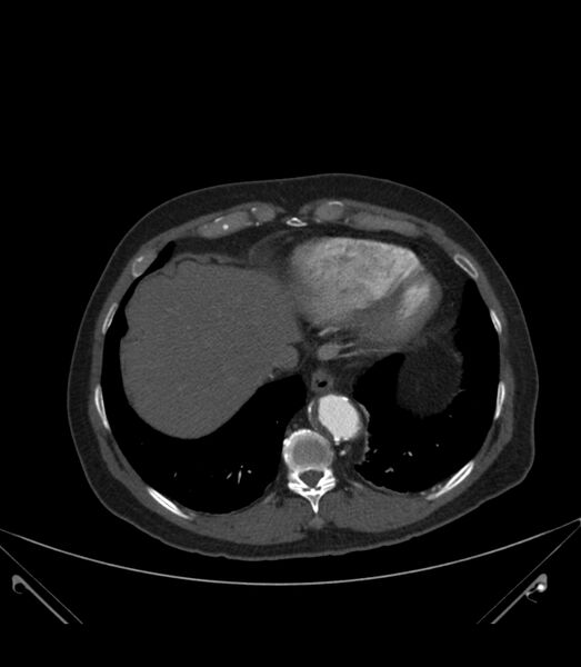 File:Abdominal aortic aneurysm with thrombus fissuration (Radiopaedia 46218-50618 Axial C+ arterial phase 4).jpg