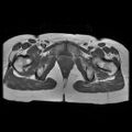 Abdominal wall endometriosis (Radiopaedia 83702-98847 Axial T1 17).jpg