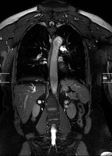 File:Aberrant right subclavian artery with background Takayasu arteritis (Radiopaedia 21423-21363 Coronal MRA 21).jpg
