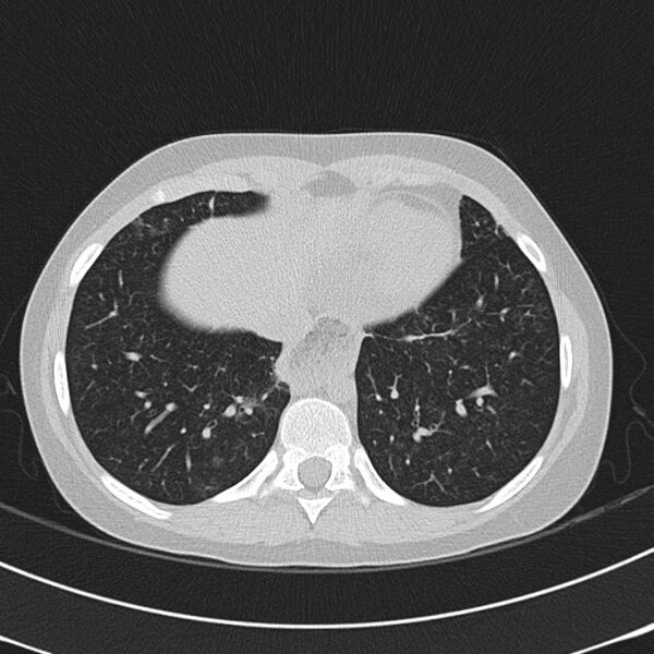 File:Achalasia (Radiopaedia 14946-14878 Axial lung window 61).jpg