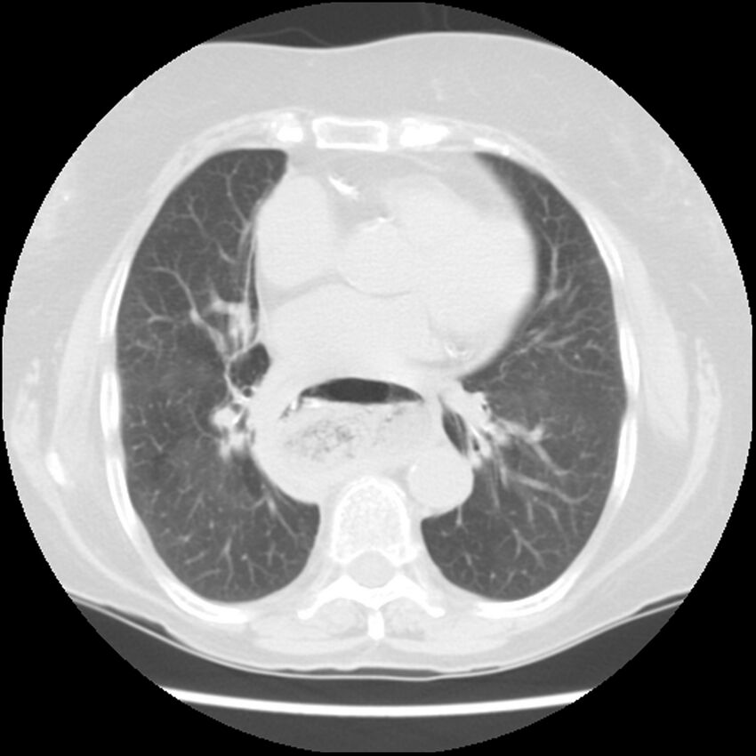 Achalasia (Radiopaedia 44094-47649 Axial lung window 34).jpg