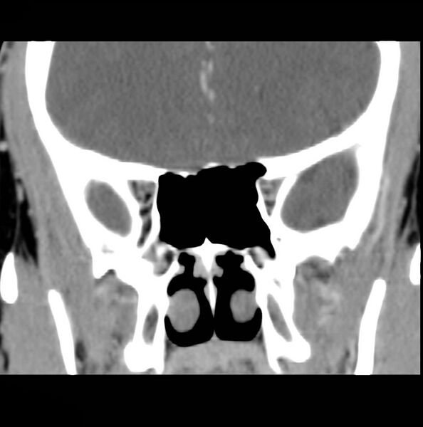 File:Acinic cell carcinoma of the lacrimal gland (Radiopaedia 9480-10160 Coronal C+ arterial phase 10).jpg
