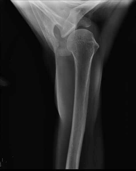 File:Acromial fracture (Radiopaedia 30094-30683 Axial view 1).jpg