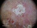 Actinic Keratoses affecting the legs and feet (DermNet NZ lesions-ak-legs-506).jpg