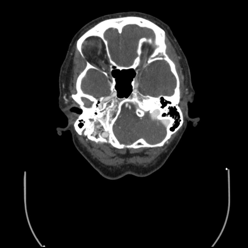 Acute M1 occlusion with ischemic penumbra (CT perfusion) (Radiopaedia 71897-82344 Axial C+ arterial phase thins 125).jpg