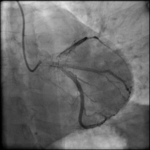 File:Acute anteroseptal myocardial infarction (Radiopaedia 68409-77946 LAO caudal (spider view) LAD and CX 41).jpg