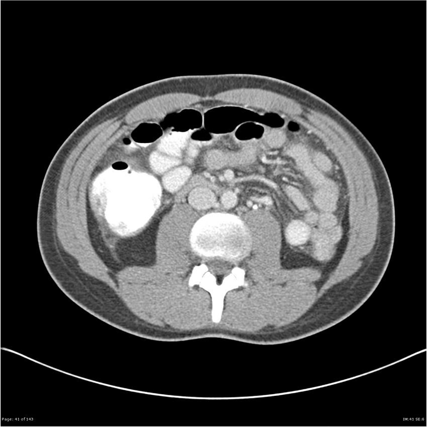 Acute appendicitis (Radiopaedia 25364-25615 B 31).jpg
