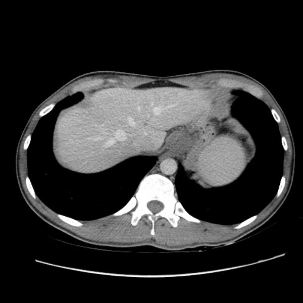 File:Acute appendicitis (Radiopaedia 27049-27227 Axial C+ portal venous phase 10).jpg