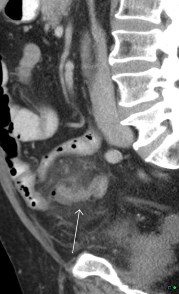 File:Acute appendicitis arising from a malrotated cecum (Radiopaedia 19970-19997 D 1).jpg