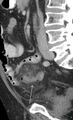 Acute appendicitis arising from a malrotated cecum (Radiopaedia 19970-19997 D 1).jpg