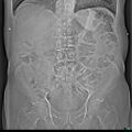 Acute appendicitis arising from a malrotated cecum (Radiopaedia 19970-19997 scout 1).jpg