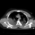 Acute aspiration pneumonitis (Radiopaedia 33605-34703 Axial non-contrast 33).jpg