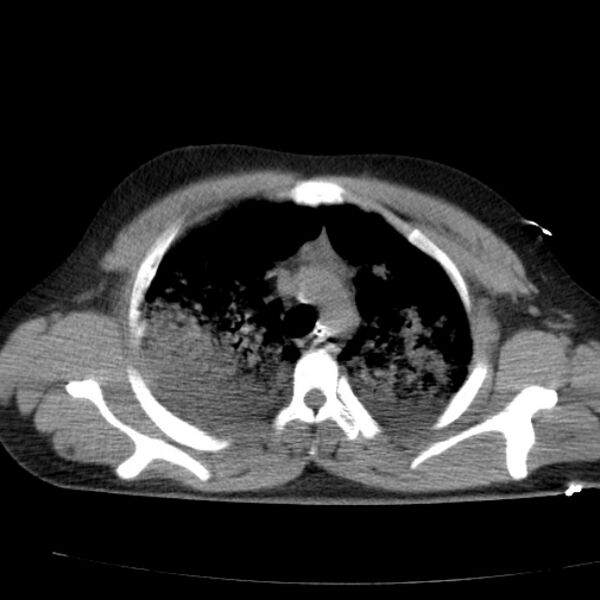 File:Acute aspiration pneumonitis (Radiopaedia 33605-34703 Axial non-contrast 33).jpg