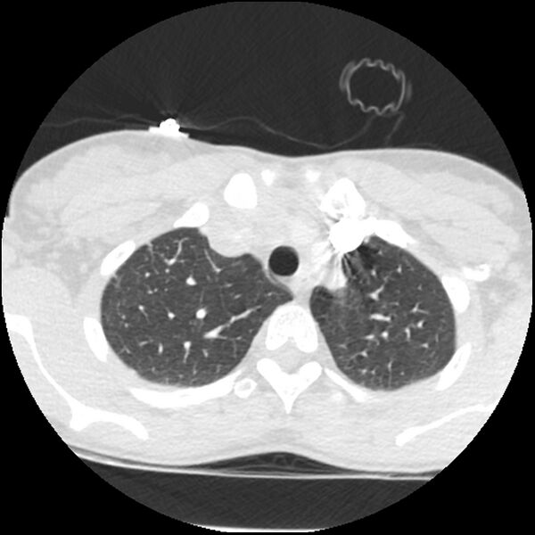 File:Acute chest syndrome - sickle cell disease (Radiopaedia 42375-45499 Axial lung window 40).jpg