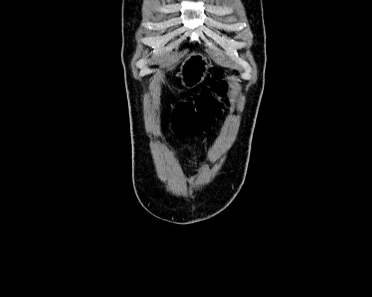 File:Acute cholecystitis (Radiopaedia 53216-59182 Coronal C+ portal venous phase 1).jpg