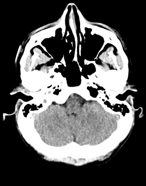 File:Acute disseminated encephalomyelitis (ADEM) (Radiopaedia 65319-74348 Axial non-contrast 7).png