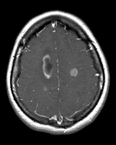 File:Acute disseminated encephalomyelitis (Radiopaedia 2576-6271 Axial T1 C+ 1).jpg