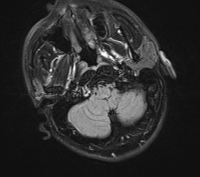 File:Acute ischemic stroke - posterior circulation territory (Radiopaedia 77670-89880 Axial FLAIR 3).jpg
