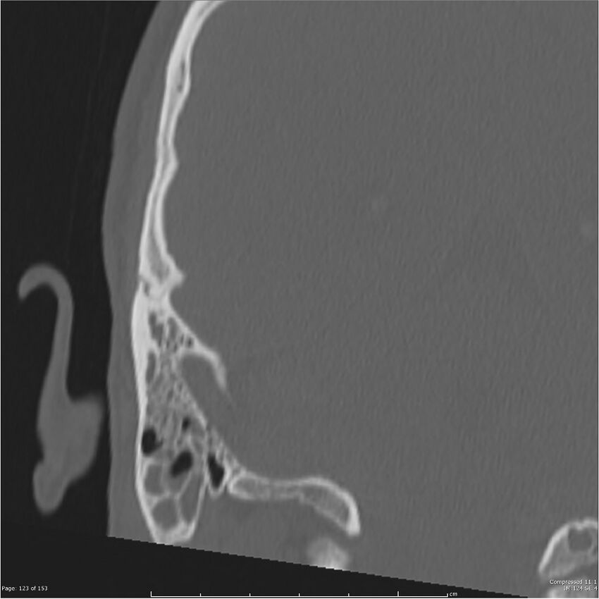 Acute otomastoiditis (Radiopaedia 28276-28512 Coronal PTB bone window reformat 54).jpg