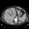 Acute pancreatic necrosis (Radiopaedia 13560-18503 Axial C+ portal venous phase 17).jpg