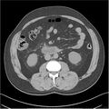 Acute pancreatitis - mild (Radiopaedia 27796-28033 Axial non-contrast 26).jpg