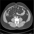 Acute pancreatitis - mild (Radiopaedia 27796-28033 C+ portal venous phase 36).jpg