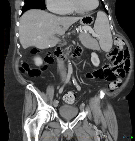 File:Acute renal failure post IV contrast injection- CT findings (Radiopaedia 47815-52559 Coronal C+ portal venous phase 12).jpg