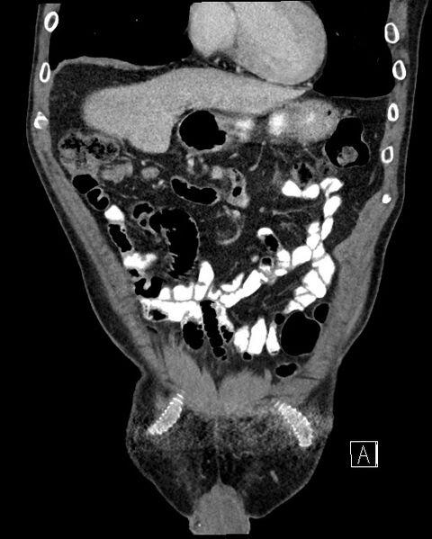 File:Acute renal infarction - rim capsular enhancement (Radiopaedia 59833-67270 Coronal C+ portal venous phase 4).jpg
