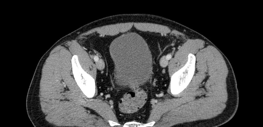 Acute sigmoid colon diverticulitis (Radiopaedia 55507-61976 Axial C+ portal venous phase 99).jpg