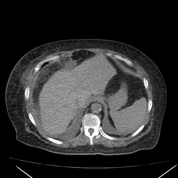 File:Acute tubular necrosis (Radiopaedia 28077-28334 Axial non-contrast 14).jpg