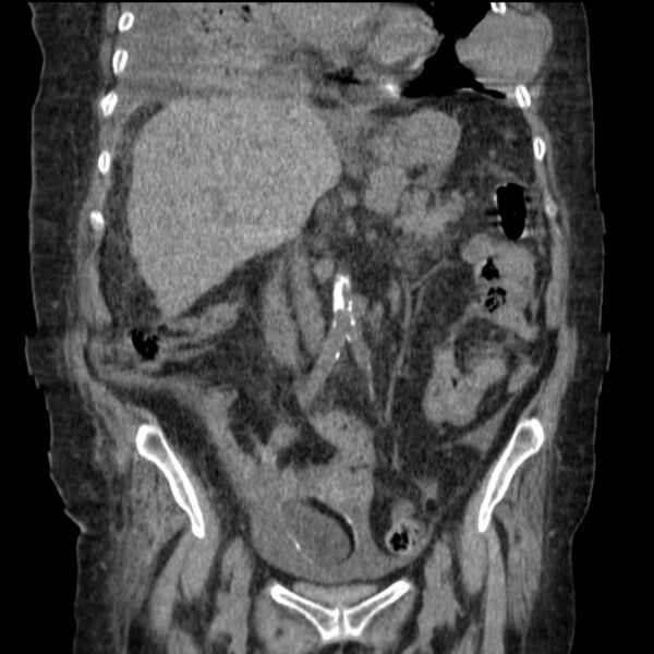 File:Acute tubular necrosis (Radiopaedia 28077-28334 G 43).jpg