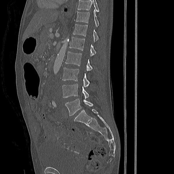 File:Acute vertebral body compression fractures (Radiopaedia 31757-32693 Sagittal bone window 22).jpg