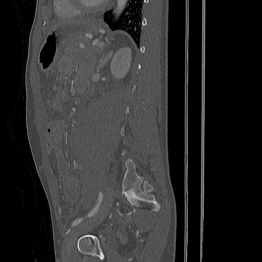 Acute vertebral body compression fractures (Radiopaedia 31757-32693 Sagittal bone window 7).jpg
