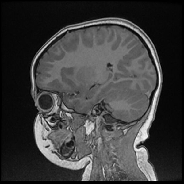 File:Adamantinomatous craniopharyngioma (Radiopaedia 77407-89529 Sagittal T1 C+ 90).jpg
