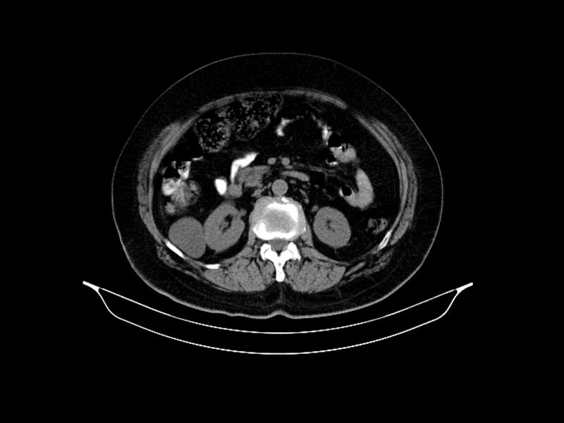 File:Adenocarcinoma of pancreas with hepatic metastasis (Radiopaedia 64332-73122 Axial non-contrast 46).jpg