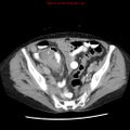 Adenocarcinoma of the colon (Radiopaedia 8191-9039 Axial renal excretory phase 47).jpg
