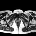 Adenomyoma of the uterus (huge) (Radiopaedia 9870-10438 Axial T2 2).jpg
