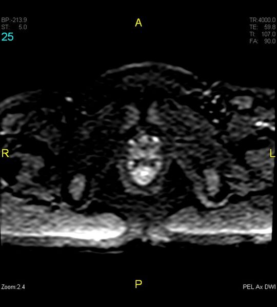 File:Adenomyosis (Radiopaedia 43504-46889 Axial DWI 25).jpg